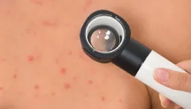 预防过敏的4大食物