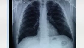 食用海蜇的功效 清肺补碘防疾病