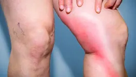 痛风什么东西不能吃