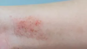 蝎子能治皮肤病癣病吗