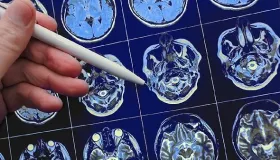 脑梗可以喝牛奶吗