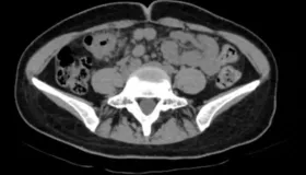 别把“排便后腹痛缓解”当小事！年轻女孩的经历警示：肠癌信号可能很隐蔽