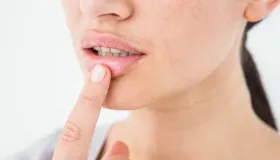 唇炎的辨证论治。