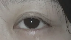 迎风流泪的辨证论治