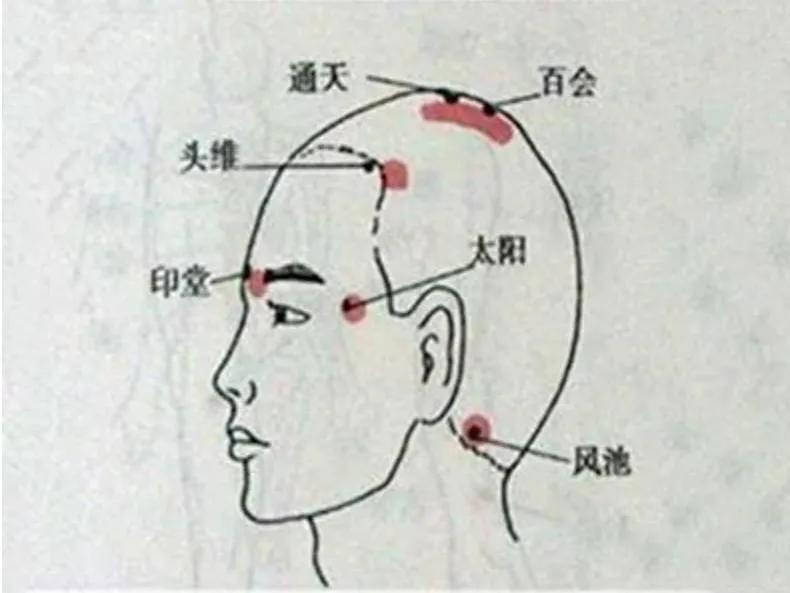 脱发有妙招：梳头与茯苓汤双管齐下，重焕秀发活力插图