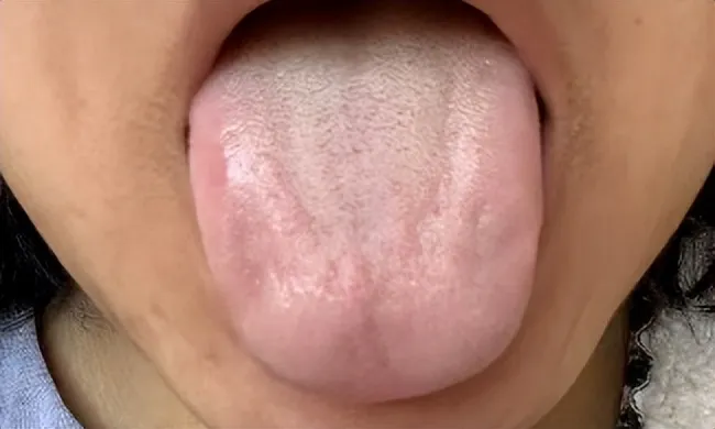 中医解读：痰湿蕴肺致脱发，祛湿健脾重拾浓密乌发 —— 陆先生的脱发康复案例插图1