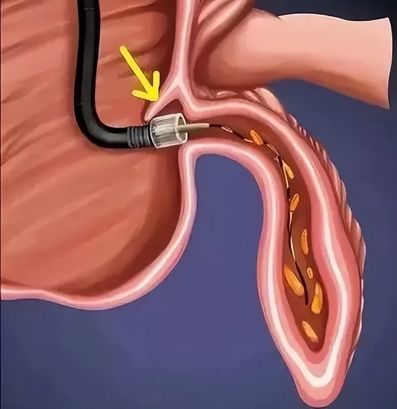 不开刀治阑尾炎！ERAT微创技术让他快速康复，还意外揪出肠道隐患插图2