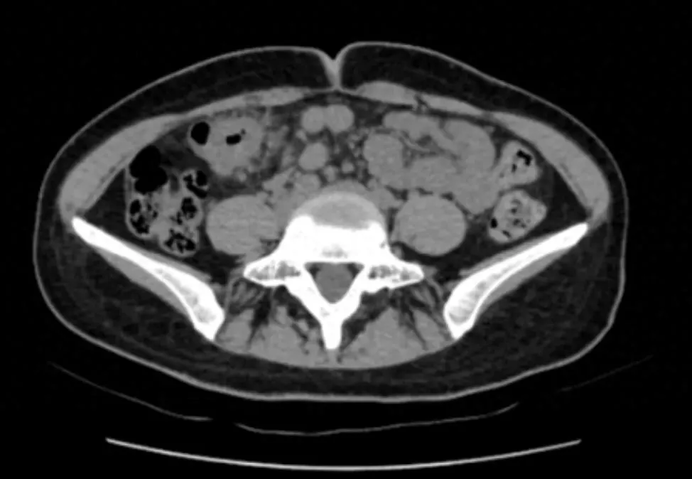别把“排便后腹痛缓解”当小事！年轻女孩的经历警示：肠癌信号可能很隐蔽插图