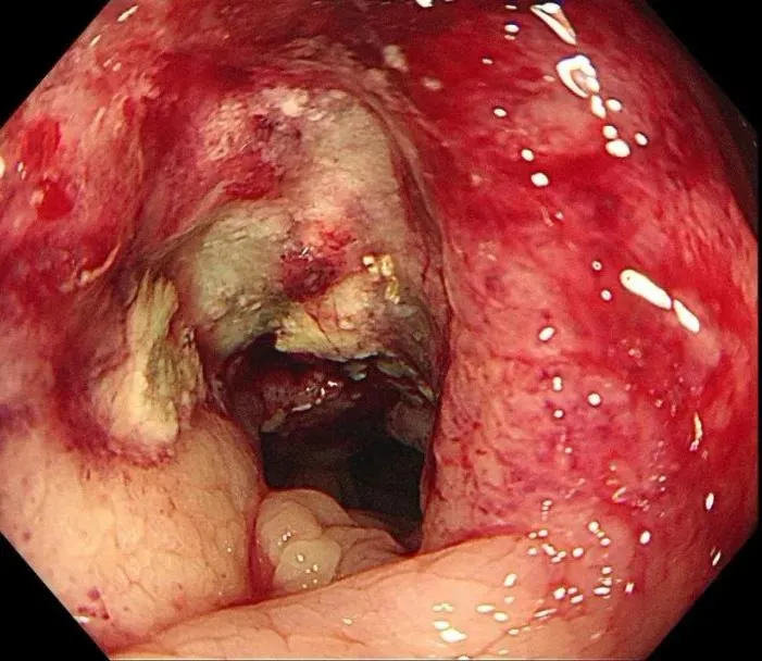 别把“排便后腹痛缓解”当小事！年轻女孩的经历警示：肠癌信号可能很隐蔽插图1