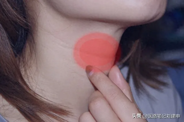 咽干、咽痛，喝一个中成药就好了。经验分享。插图