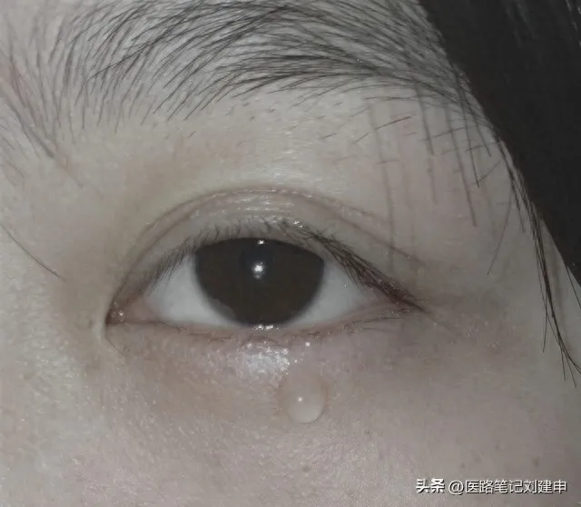 迎风流泪的辨证论治插图