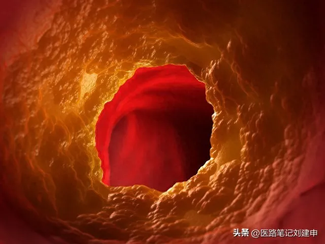 多发性子宫息肉，速消案例分享插图