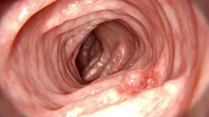 胃镜后一定得吃2天流食吗插图1