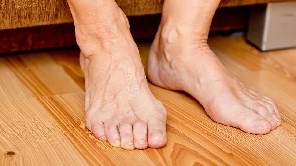 痛风什么东西不能吃插图1