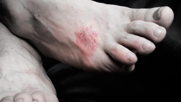 醋精能治皮肤病吗插图