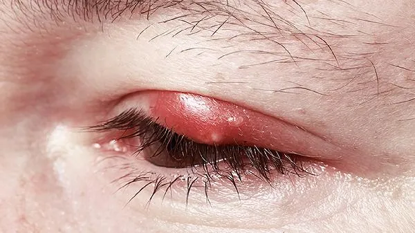 眼睛哭肿了怎么消肿插图1