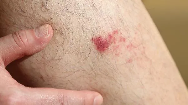 苦橙对皮肤的伤害插图2