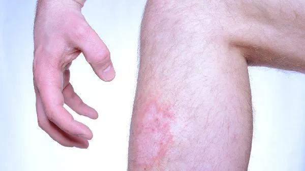 蝎子能治皮肤病癣病吗插图1