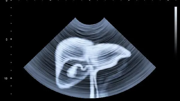 腹部肉松弛是什么原因导致的插图1