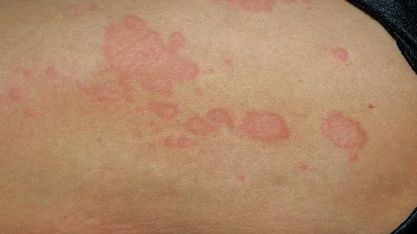 醋精能治皮肤病吗插图1