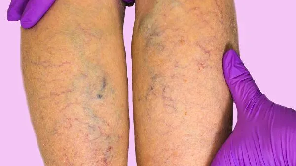 面部浮肿怎么办好呢插图2