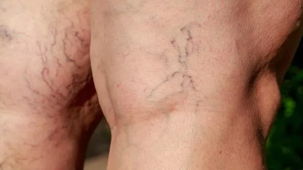 面部浮肿怎么办好呢插图1