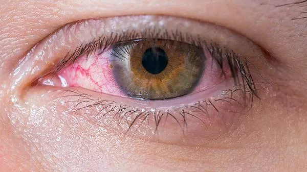 辣椒辣到眼睛了最快消除方法插图