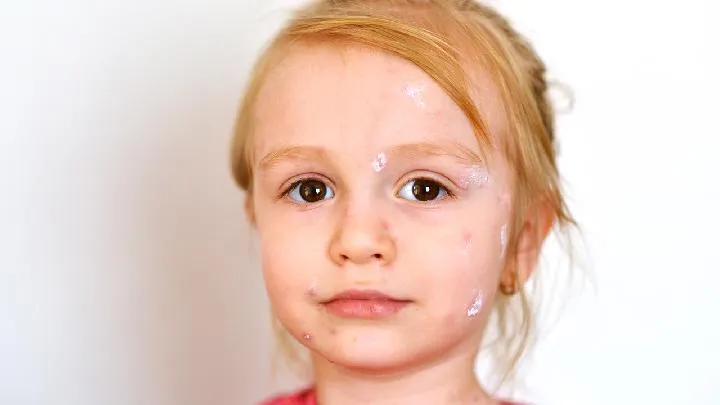 长水痘可以吃羊肉吗插图1