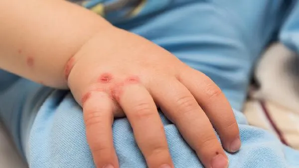 透明质酸是什么？它对皮肤有哪些功效呢？插图