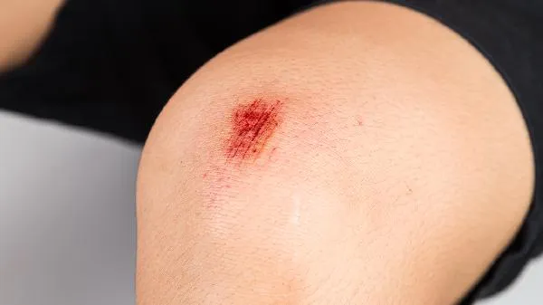 透明质酸是什么？它对皮肤有哪些功效呢？插图1